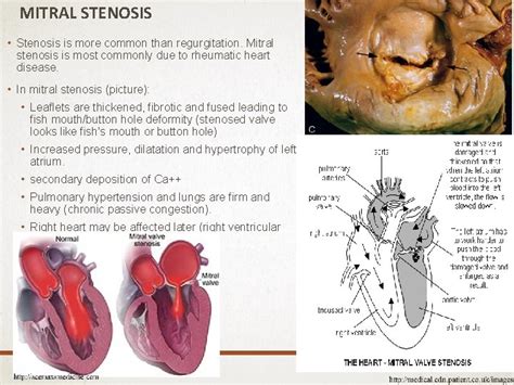 Pathology Of Rheumatic Heart Disease Infective Endocarditis And