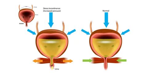 Urinary Incontinence Causes Types And Treatment