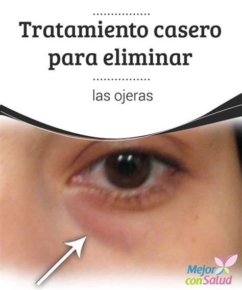 Tratamiento Casero Para Eliminar Las Ojeras Te Sientes Frustrada