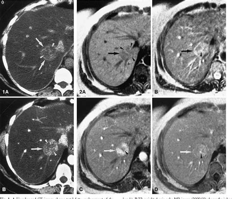 Intratumoral Steatosis In Focal Nodular Hyperplasia Coinciding With