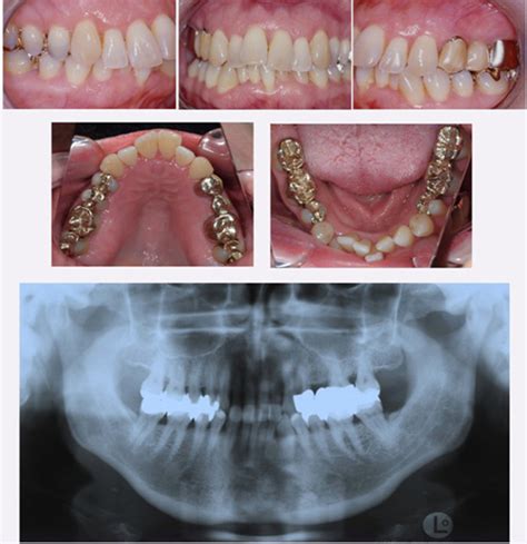 Pretreatment Intraoral Photographs And Panoramic Radiograph Download