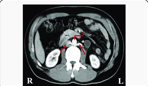 Axial Contrast Enhanced Computed Tomography Ct Image Revealed Rlrv