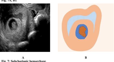 Figure 1 From A Logistic Model Of Early Pregnancy Ultrasound