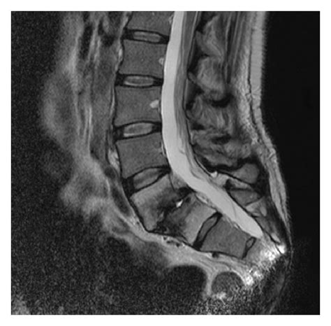 T1 A And T2 B Sagittal Lumbar Mri Showing An L5s1 Severe