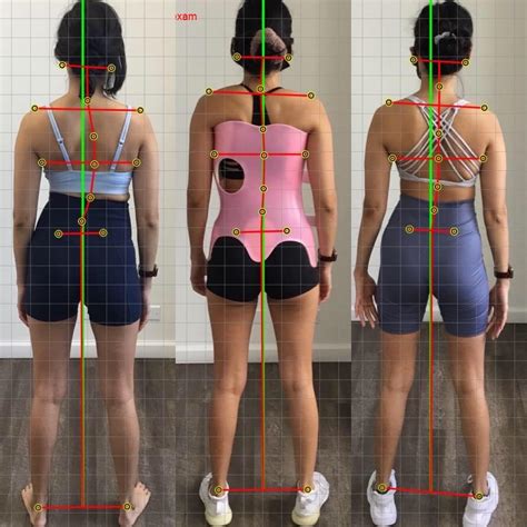 Scoliosis Awareness Is More Than Just The Cobb Angle Foundation Spine