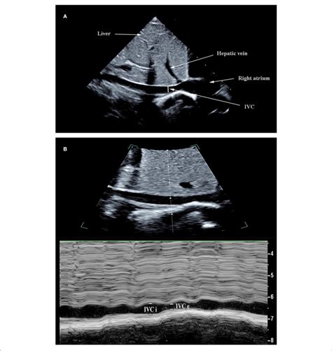 Ultrasonographic Measurement Of Inferior Vena Cava Ivc Diameters