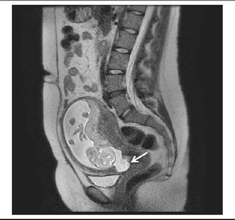 Figure 1 from Sonographic Assessment of Uterine Dehiscence During ...