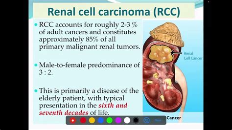 Renal Cell Carcinoma Rcc Aetiology Histopathology Spread Youtube