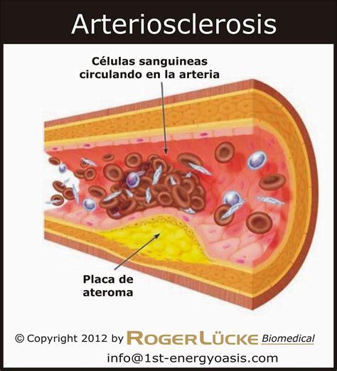 Entrevista La Aterosclerosis Una Enfermedad Prevenible Y Tratable