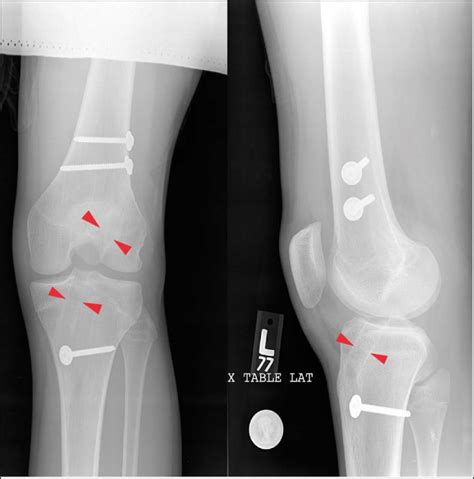 Anteroposterior Ap And Lateral Radiographs Of The Left Knee In A Download Scientific Diagram