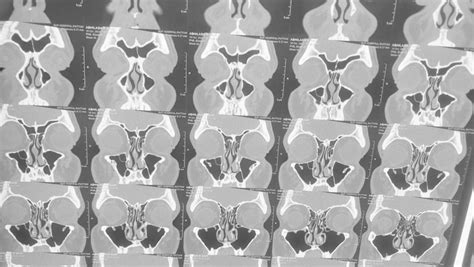 Bilateralal Alveolar Recess Cells Download Scientific Diagram