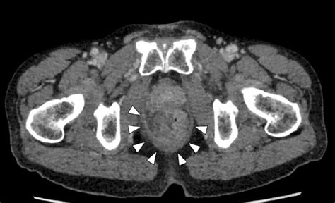 Figure1a Contrast Enhanced Computed Tomography Scan On Admission