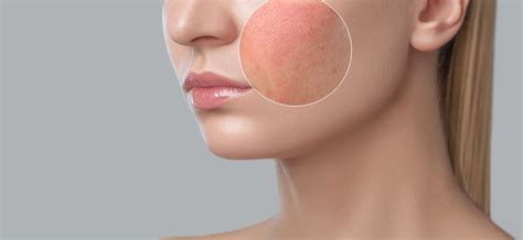 Causes Of Rashes On The Face In Women Healthy Food Near Me