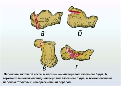 Перелом пяточной кости со смещением и без: симптомы, лечение и ...