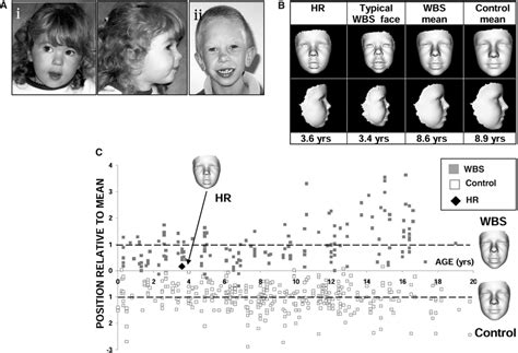 Craniofacial Characterization Of Hr A 2d Photographs Of I Wbs