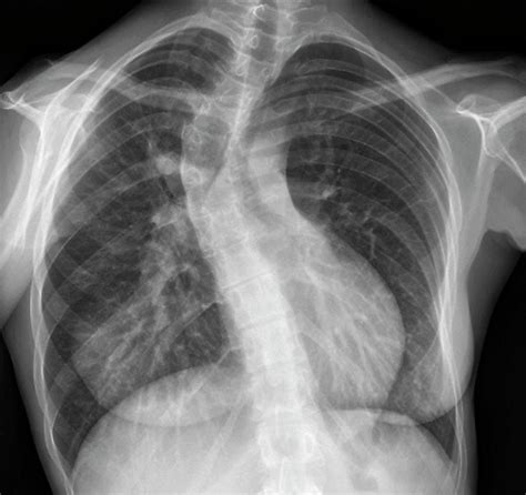 Kyphoscoliosis Photograph by Zephyr/science Photo Library