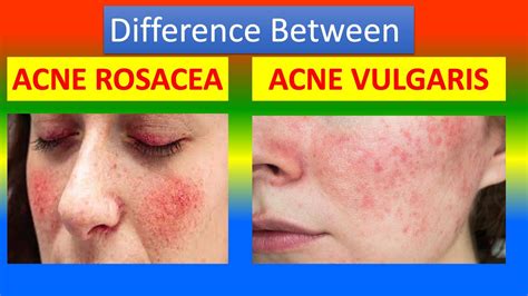 Difference Between Acne Rosacea And Acne Vulgaris Youtube