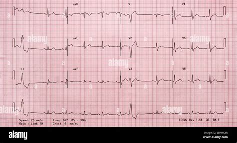 Electrocardiogram On Red Graph Paper Stock Photo Alamy