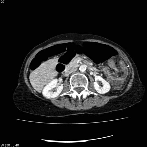 Intussusception In The Elderly Bmj Case Reports