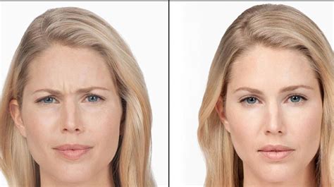 Masseter Botox Before And After A Comprehensive Guide By Jesminesid