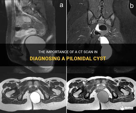 The Importance Of A Ct Scan In Diagnosing A Pilonidal Cyst Medshun