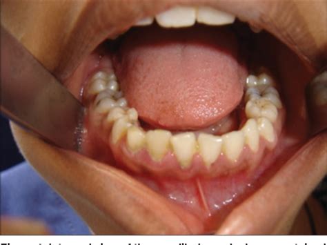 Figure 4 from Gardner's Syndrome? - It is Osteomas and Intestinal Polyposis: A Case Report ...