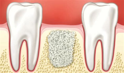 Osteonecrosis of the Jaw