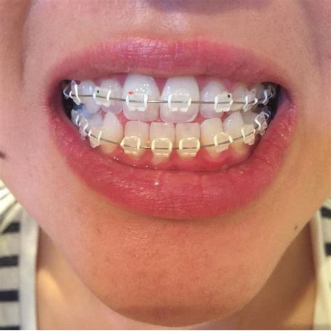 Playful And Pretty Braces Color Ideas For Everyone Healthy