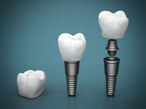 Cum funcționează implanturile dentare