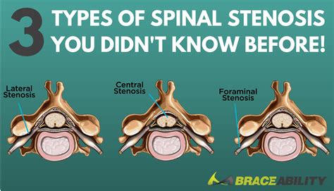 Neural Foraminal Stenosis