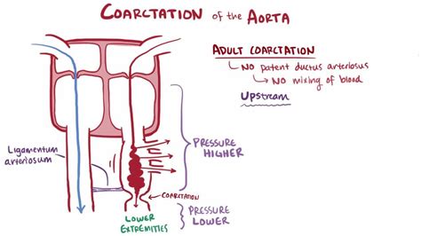 Coarctation Of The Aorta Coarctation Of The Aorta Merck Manual Professional Edition