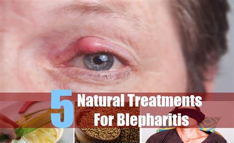 5 Natural Cures For Blepharitis Natural Treatment And Cure For