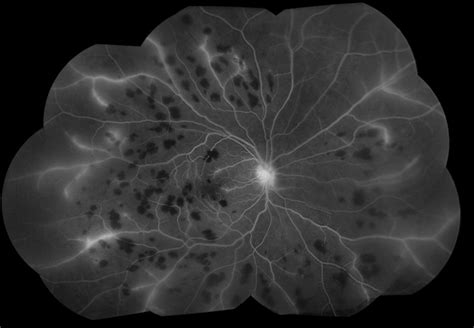 Retinal Vasculitis Due to Lupus (FA) - Retina Image Bank