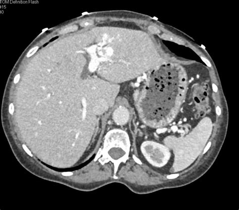 Angiodysplasia Of The Right Colon And Cavernous Transformation Of The