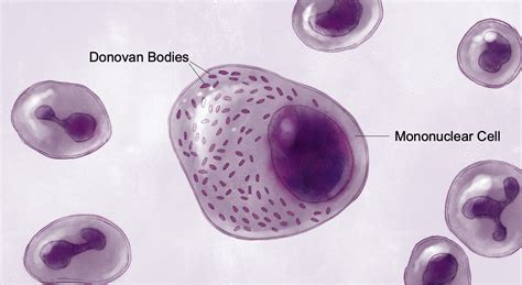 Question 4 Granuloma Inguinale Donovanosis Question Bank National