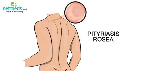 Pityriasis Rosea Causes Symptoms And Treatment Oscar Times