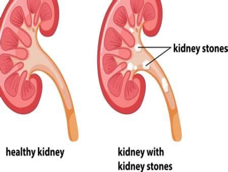 Getting rid of urinary stones is easy! | Max Hospital