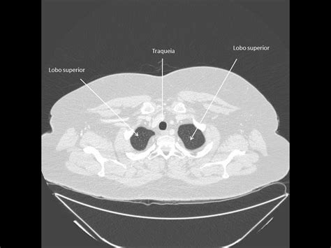 Anatomia Tc De TÓrax