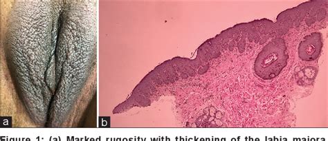 Figure From Scrotal Labia An Uncommon Presentation Of Vulvar Lichen