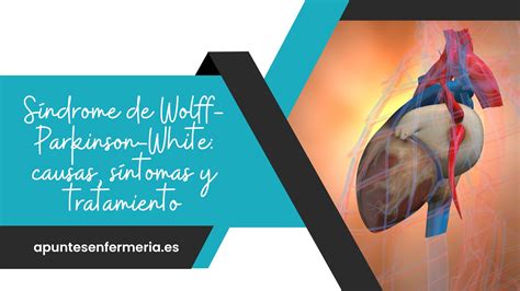 Síndrome De Wolff Parkinson White Causas Síntomas Y Tratamiento