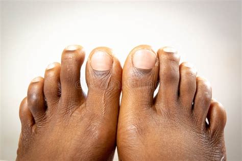 Naked Black Feet Factory Sale Emergencydentistry