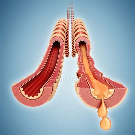 Infected Human Bronchus Health Human Anatomy Stock Photo 160554730