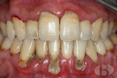 Periodoncia Clínica Dental Borrás