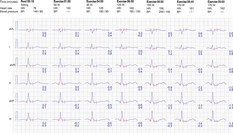 Evaluation of exercise stress test: ECG, symptoms, blood pressure ...