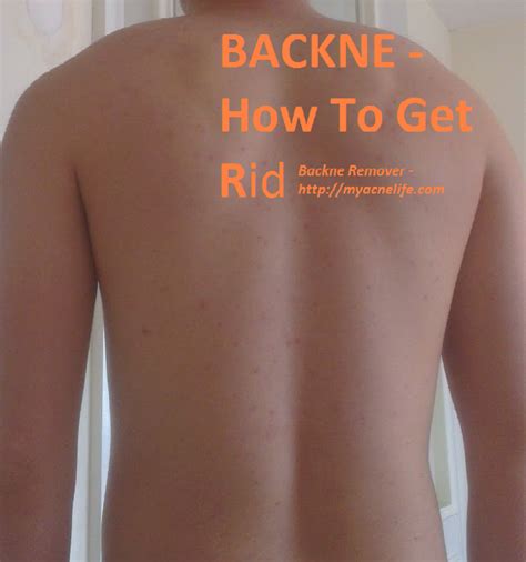 Removing Backne How To Get Rid Of Backne Fast And Safely Best Acne Treatments That Work