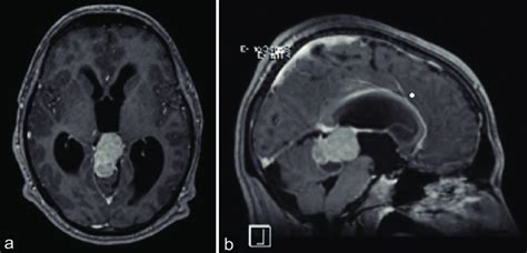 Preoperative Axial A And Sagittal B T1 Weighted Mri Images With