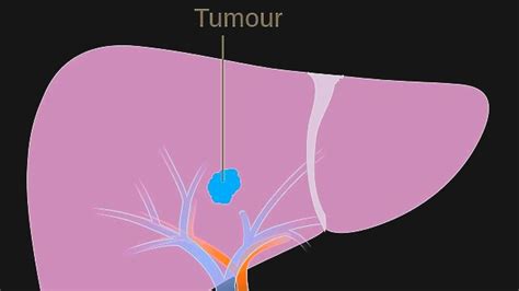 T Cell Therapy Targeting Cancer Fusion Protein May Hold Key To Treating