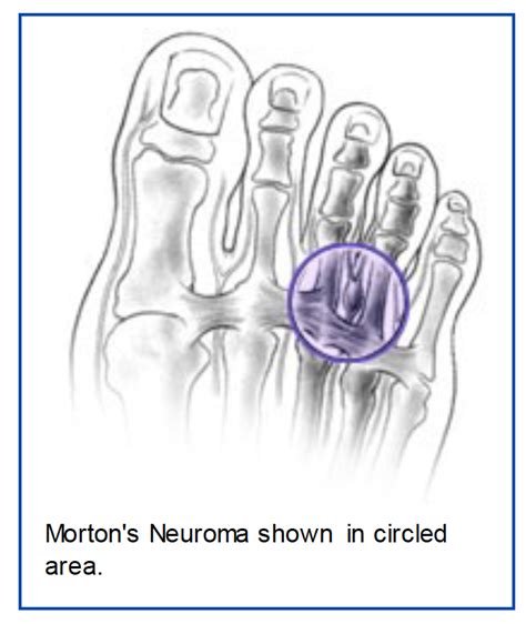 Mortons Neuroma Ankle And Foot Clinic Of Orange County