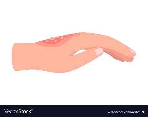 burn  hand human skin  aid  fire vector image