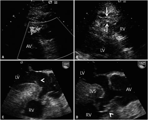 Preoperative Transthoracic And Transesophageal Echocardiography A